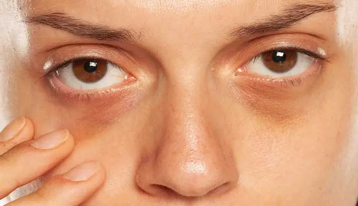 How to Get Rid of Bags Under Your Eyes: Tips and Tricks for a Brighter, Fresher Look